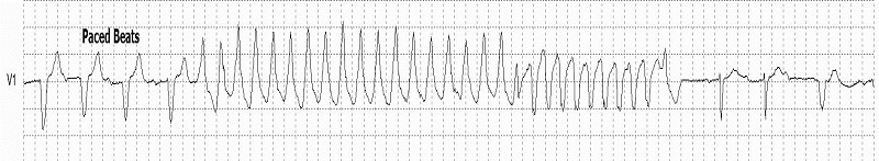 Torsades DePointes Rhythm Strip